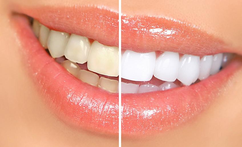 Whitening and Deep Bleaching Before and After Smile